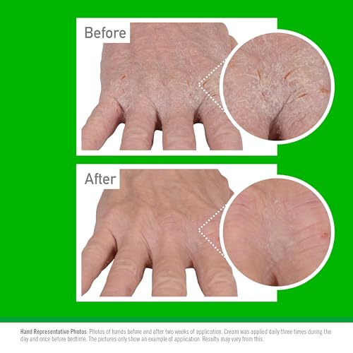 O'Keeffe's Working Hands Eczema Relief Cream for Dry, Itchy Hands, 57g 3