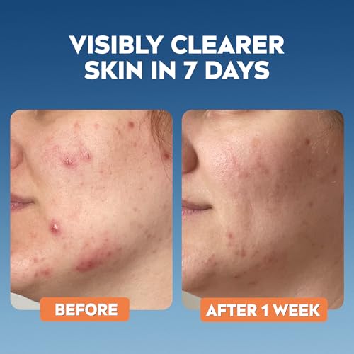 NIVEA Derma Skin Clear Toner with Salicylic Acid & Niacinamide for Blemish-Prone Skin (200ml) 10