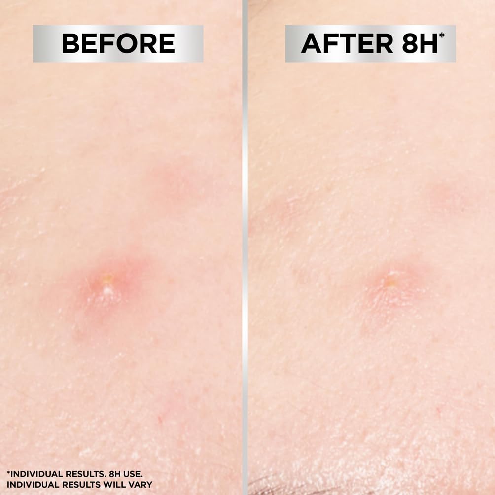 Garnier Blemish Patches: Ultra-thin Hydrocolloid Patches to Reduce Spots in 8 Hours 5