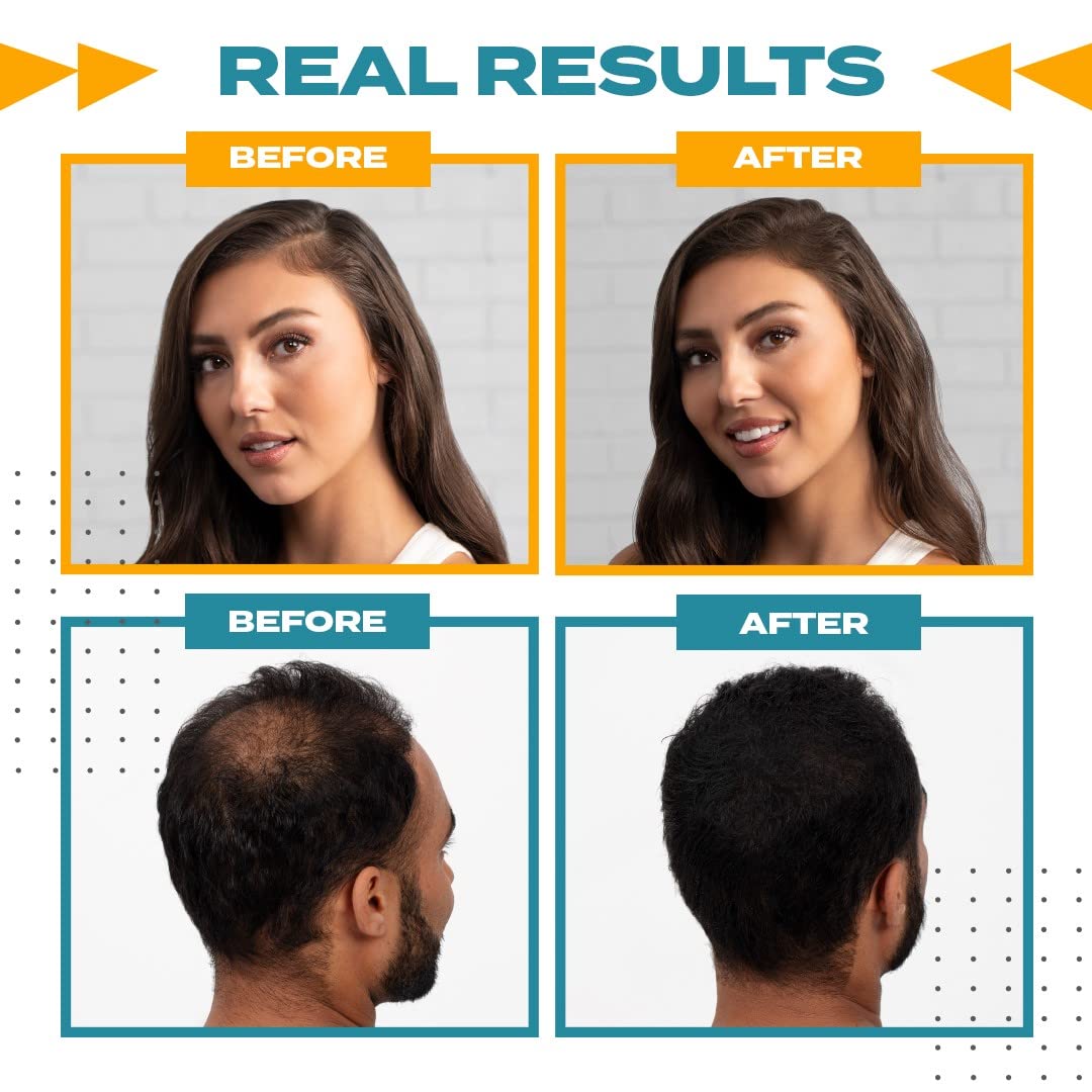 TOPPIK Hairline Optimiser for Natural Looking Hairline and Thicker Appearance 4