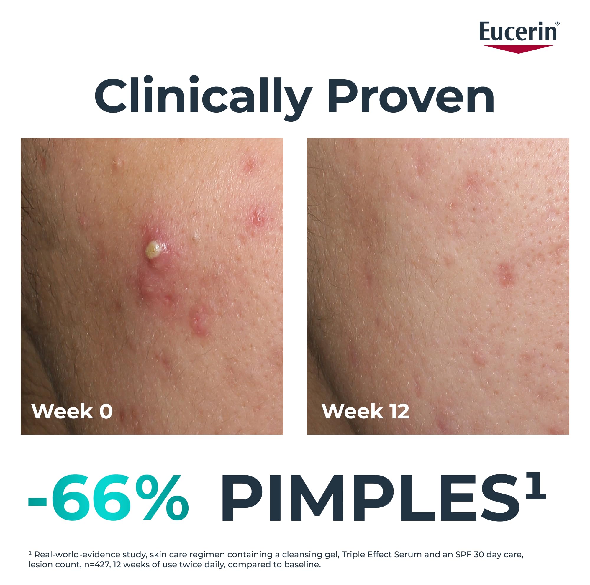 Eucerin Dermopure Clinical Triple Action Fluid 40ml Face Serum with Salicylic Acid