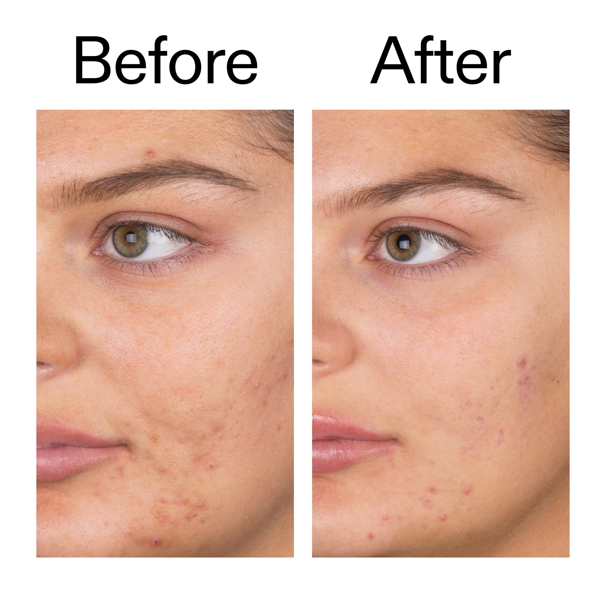 The INKEY List 2% Salicylic Acid Cleanser for Anti-Acne Face Wash (150ml) 9