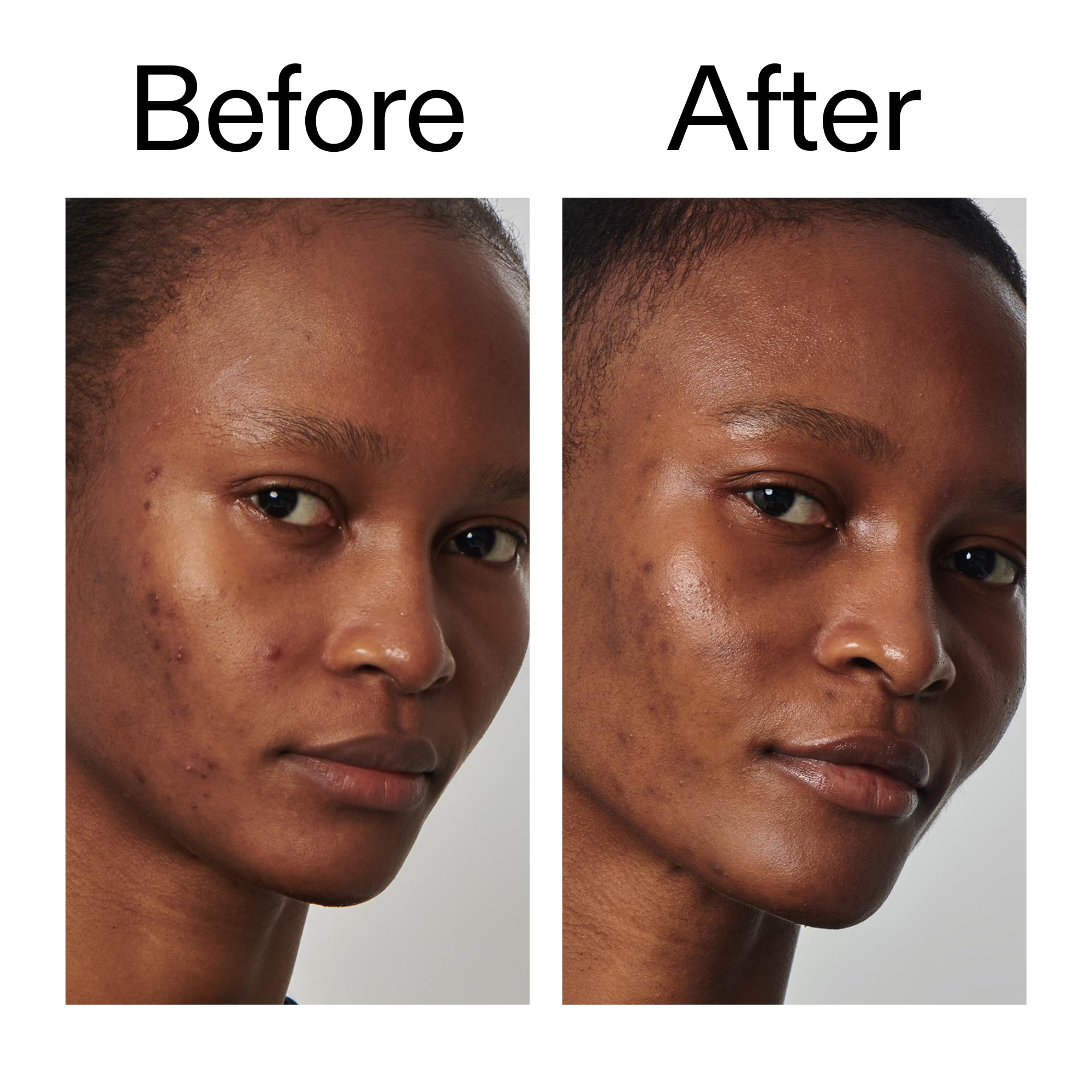 The Inkey List Niacinamide 20% Serum 30ml for Oily Skin, Redness, and Enlarged Pores 7