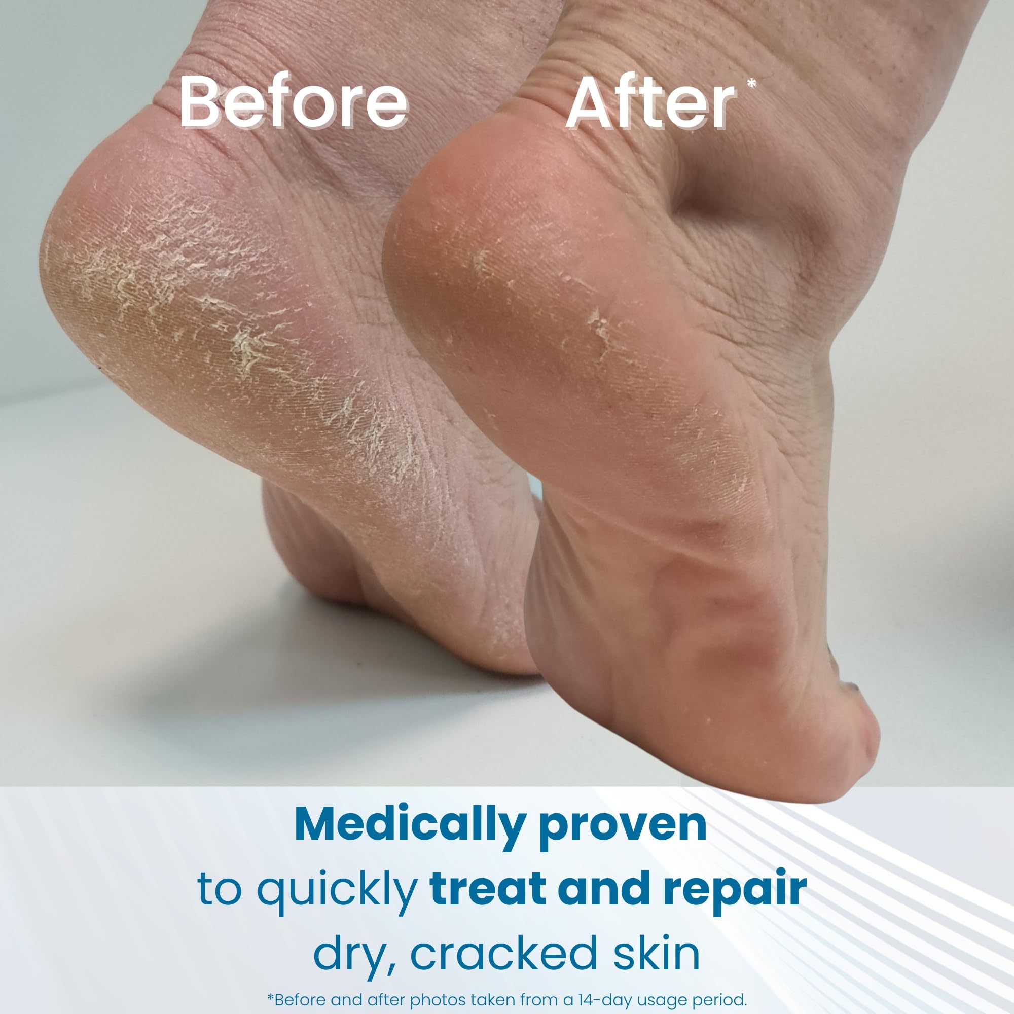 Flexitol Cracked Heel Balm for Extremely Dry Feet - Visible Results in 1 Day 5
