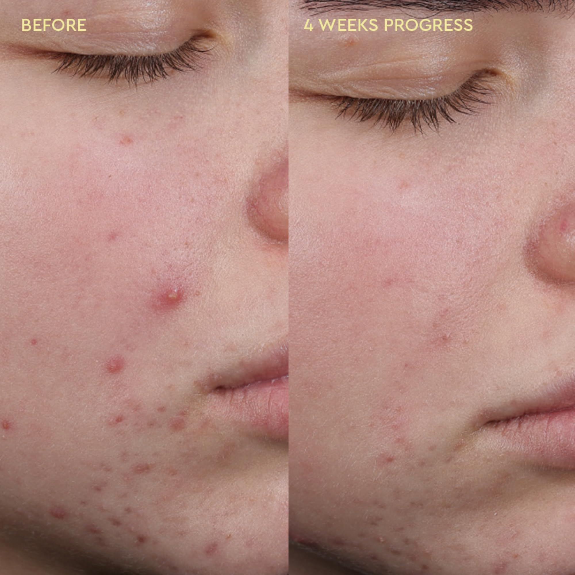 BYOMA Blemish Clearing Cleanser (175ml) for Acne-Prone Skin with Salicylic Acid 6