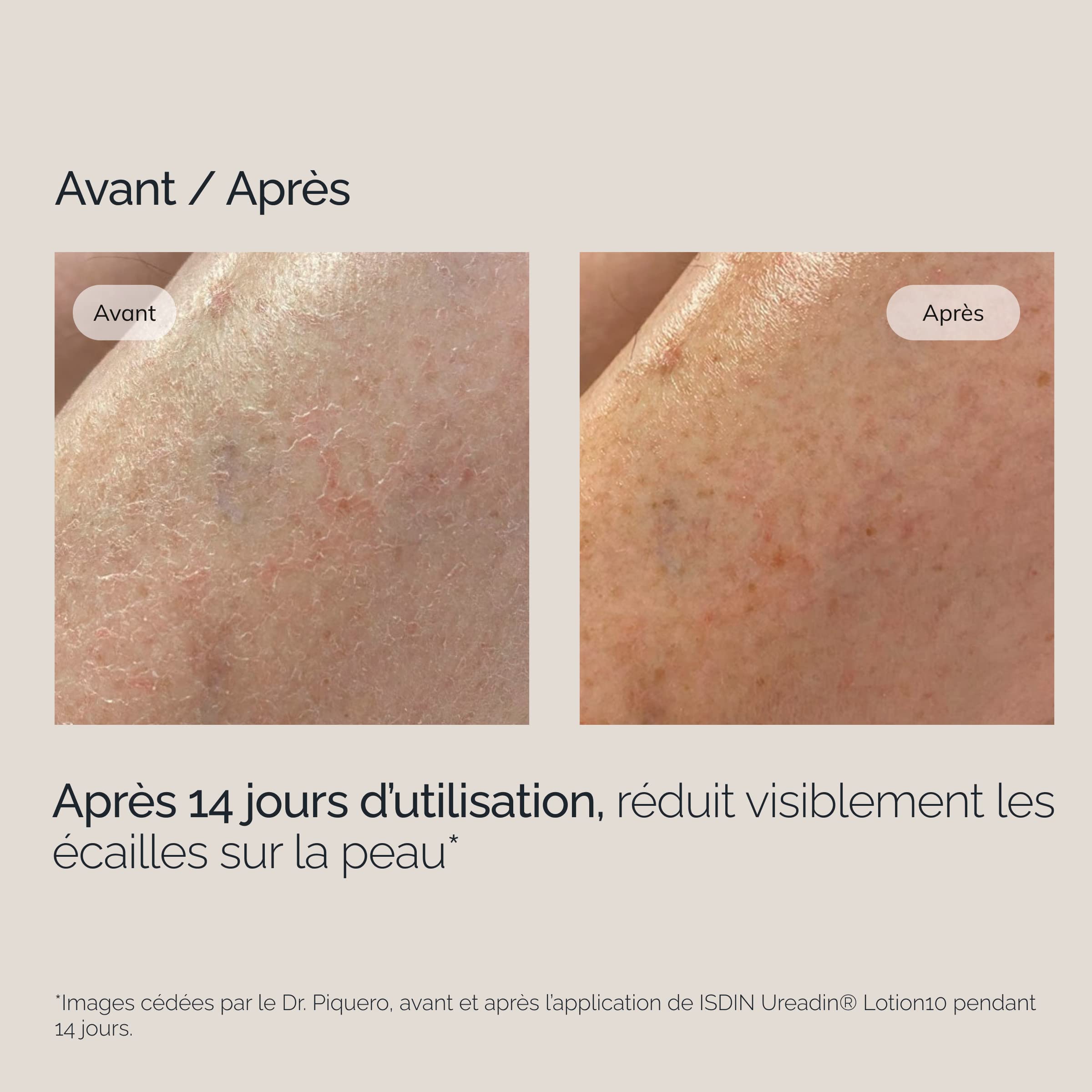 ISDIN Ureadin Ultra 10 Lotion Plus - 10% Urea Body Lotion for Very Dry & Flaky Skin 7