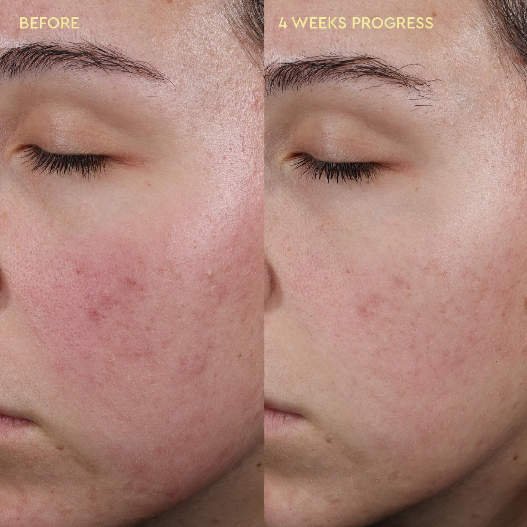 BYOMA Blemish Control Moisturiser 50ml with Salicylic Acid for Acne-Prone Skin 6