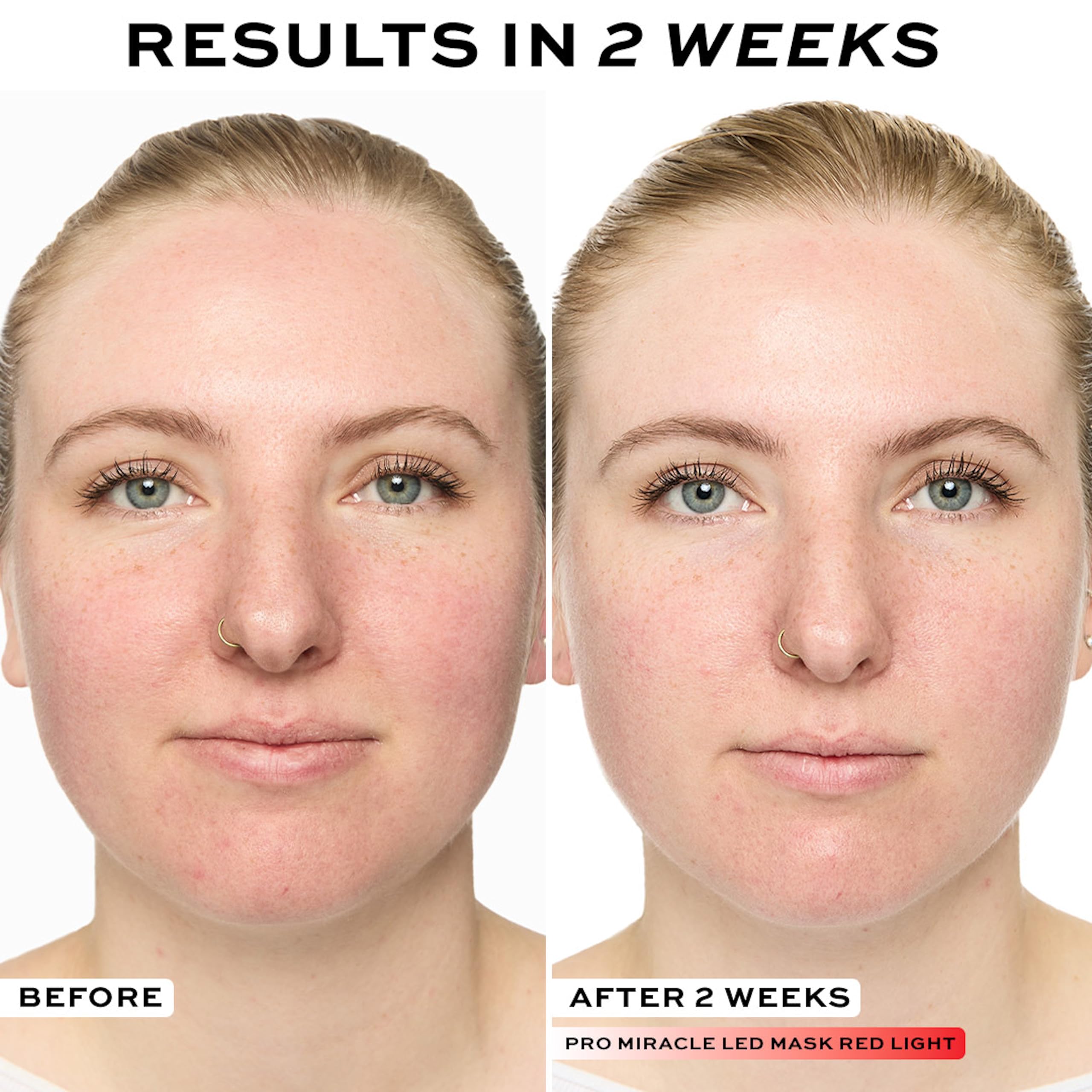 Revolution Pro Miracle LED-Gesichtsmaske: Rot- und Blaulichttherapie gegen Hautunreinheiten und feine Linien 5