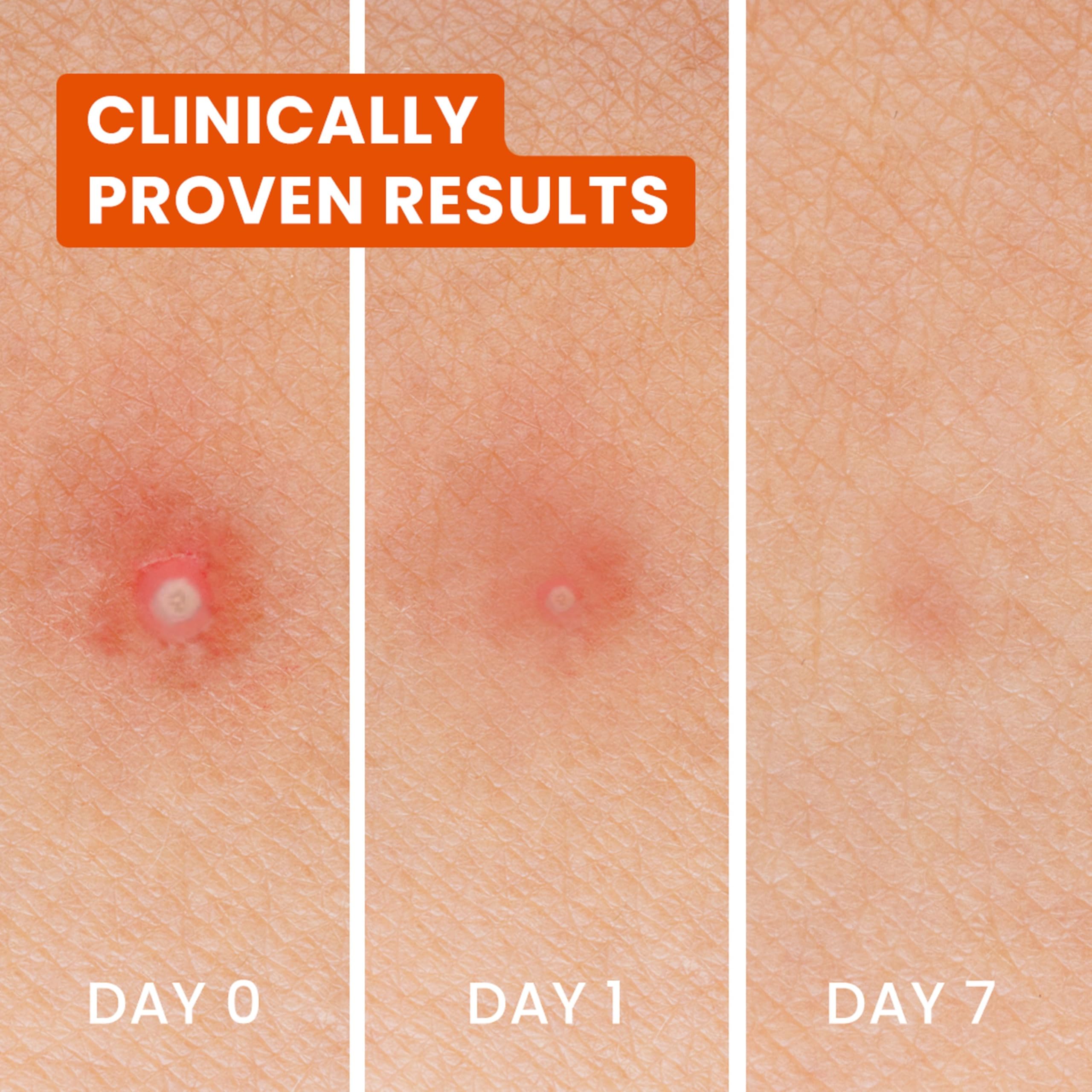 Bioré Spot Control 3-in-1 Hydrocolloid Patches with Azelaic & Tranexamic Acid 5