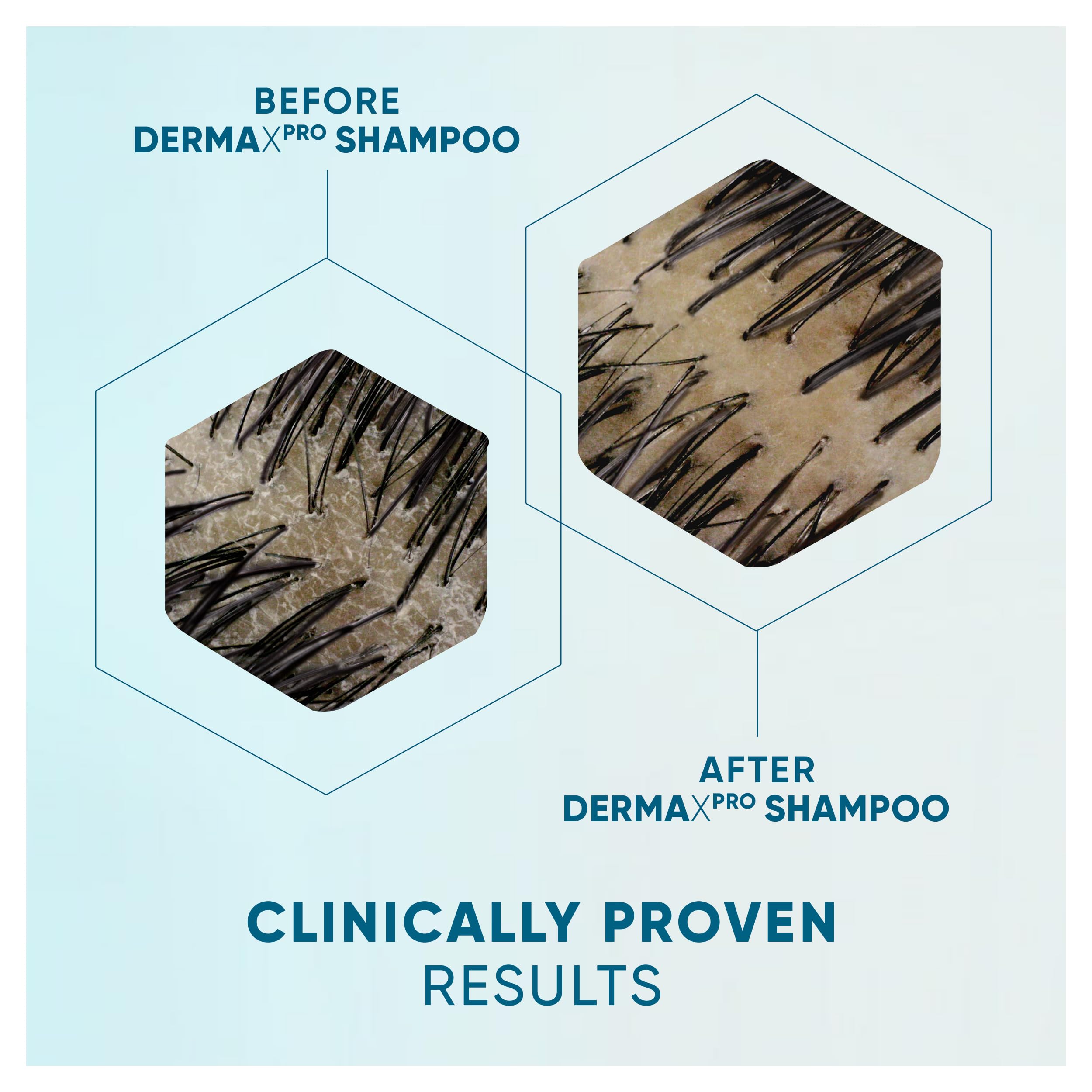 Head & Shoulders DermaX Pro Anti-Dandruff Shampoo, Conditioner & Serum Set for Dry Scalp 4