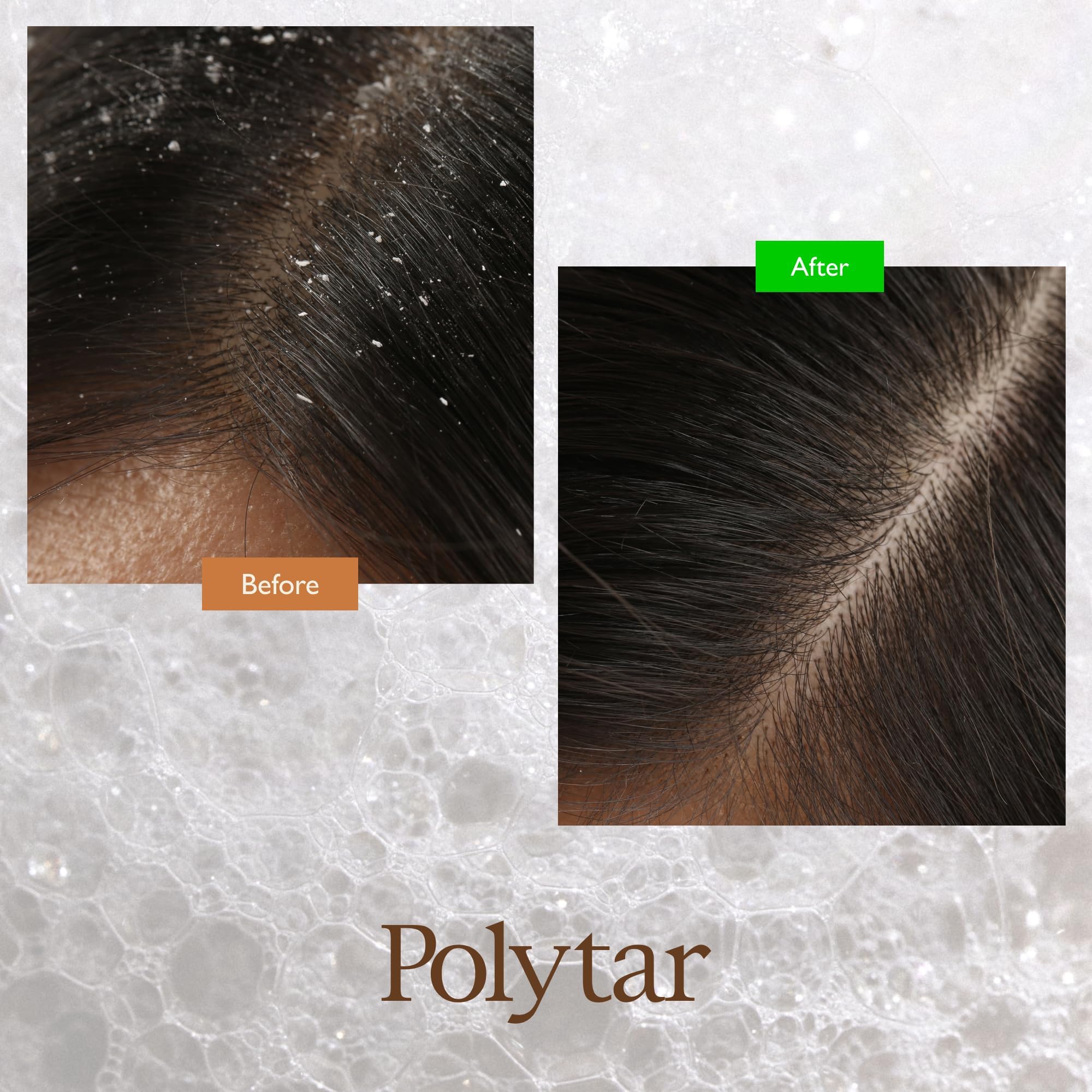 Polytar Medizinisches Kopfhautshampoo zur Linderung von Schuppenflechte, Schuppen und Juckreiz 4