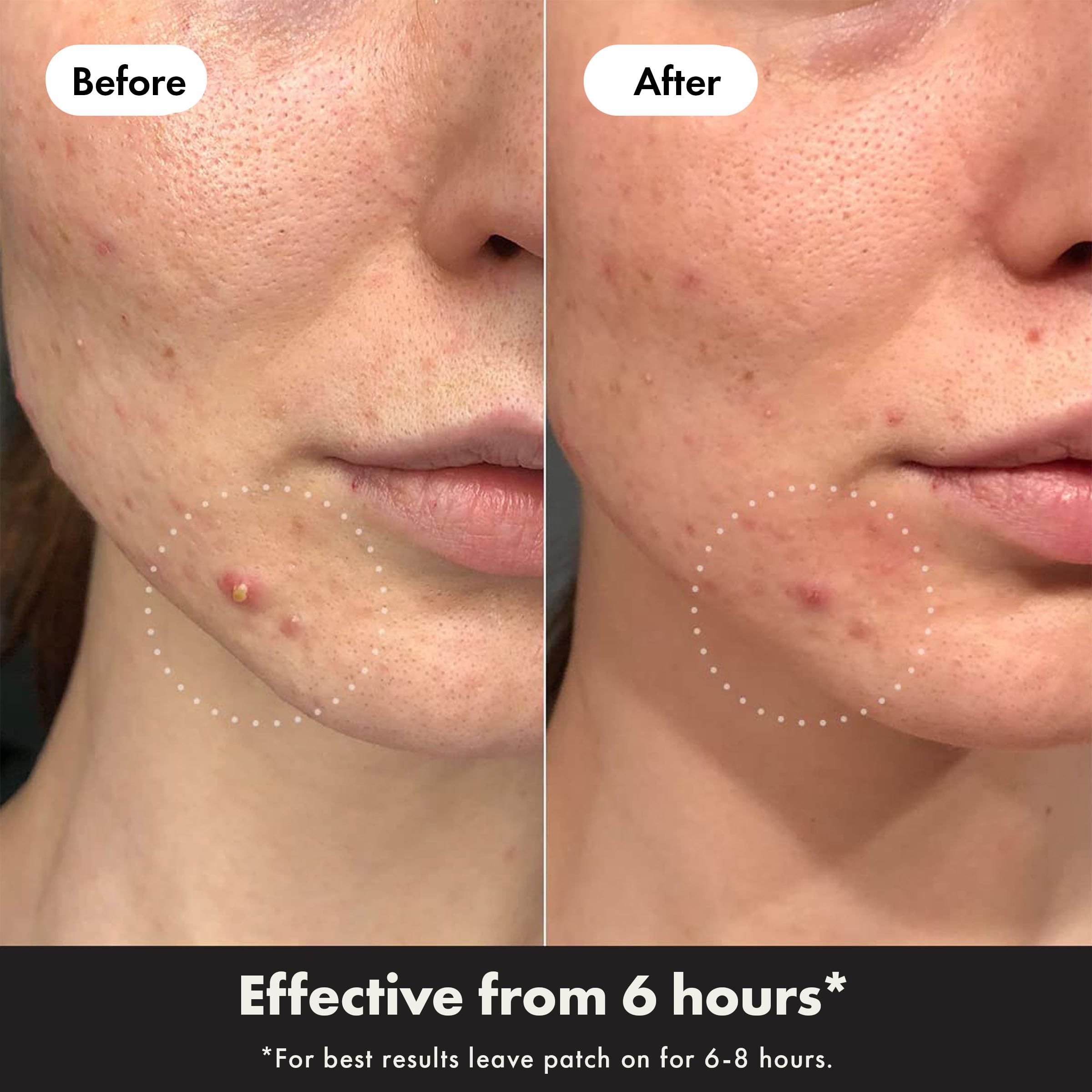 Hero Cosmetics Mighty Patch Day + Night Hydrocolloid Acne Patches (24 Count) 4