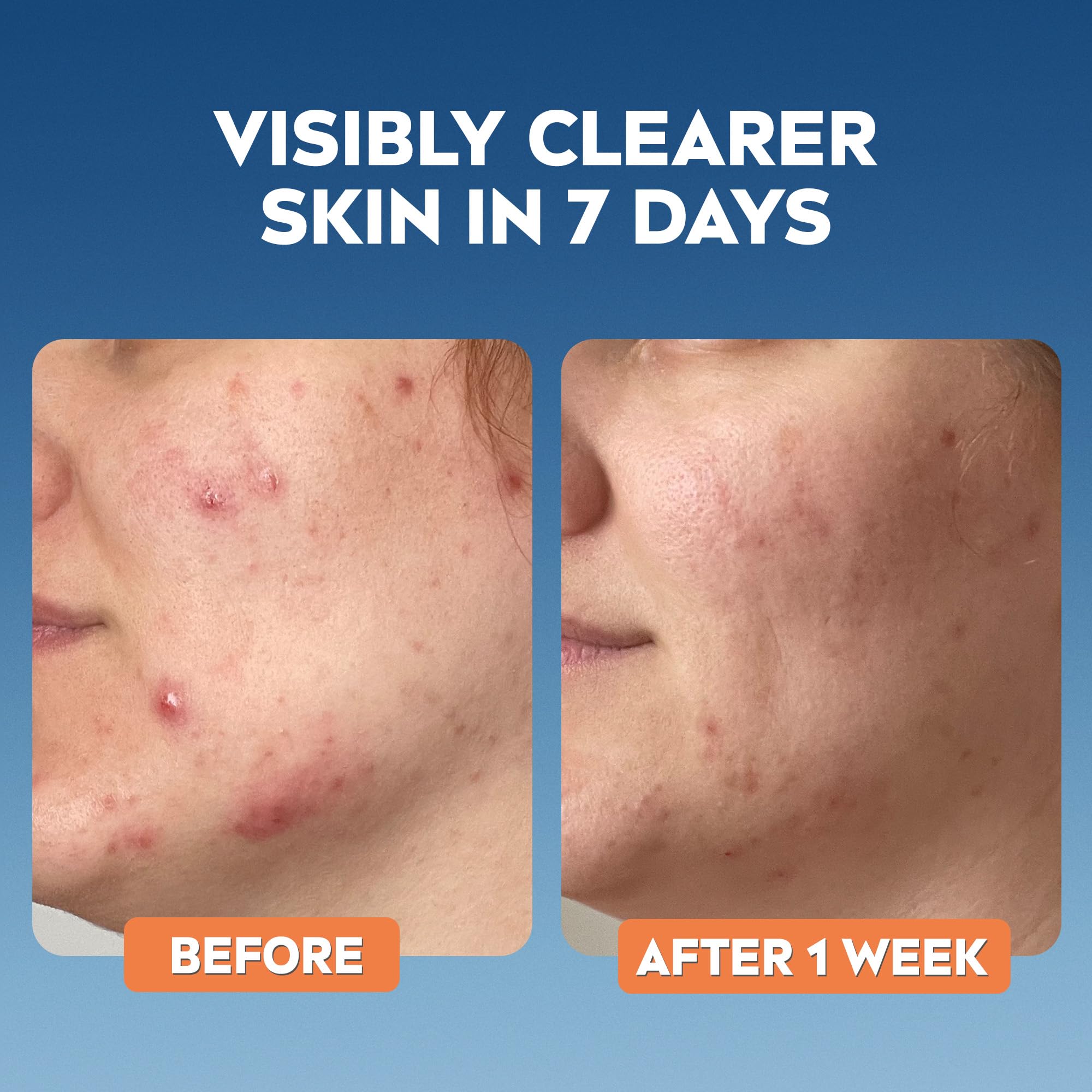 NIVEA Derma Skin Clear Chemical Exfoliator with 8% Salicylic & Glycolic Acid (40ml) 9